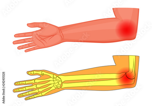Vector illustration of a human elbow joint with a pain or injury. Medial view. For advertising, medical publications