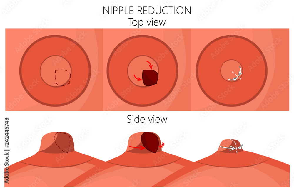 Vetor de Vector illustration of the big nipple reduction before and after  plastic surgery. Side and front view (close up) of the woman breast. For  advertising and medical publications do Stock
