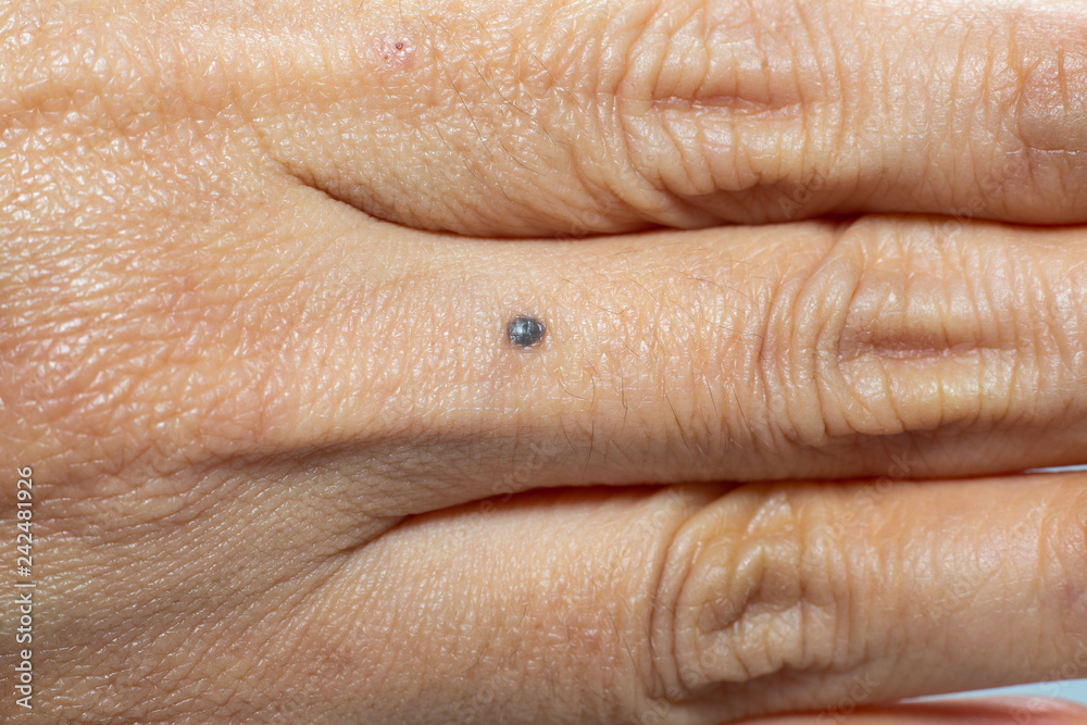 Fototapeta premium Black mole on woman's middle of finger, Close up & Macro shot, Selective focus, Medicine, Asian Body skin part, Healthcare concept, Abstract background