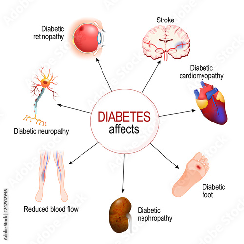 Diabetes Affects. Complications of diabetes mellitus
