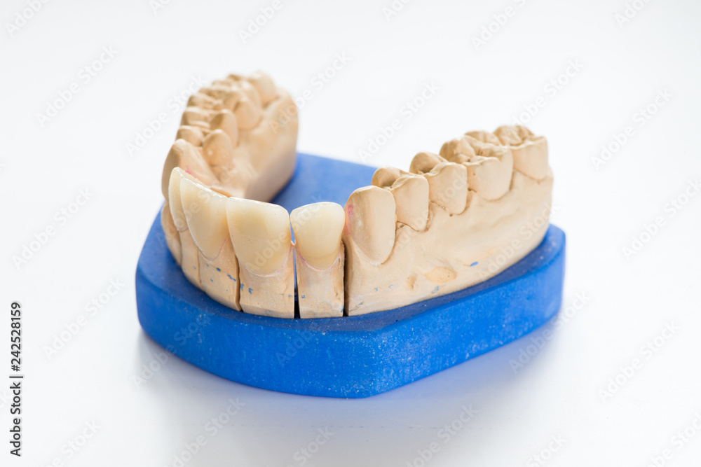 Dental gypsum model in dentist laboratory office - close-up. Gypsum Dentures with porcelain teeth isolated on white background - copy space Dental gypsum model in dentist laboratory office - close-up. Gypsum Dentures with porcelain teeth isolated on white background - copy space