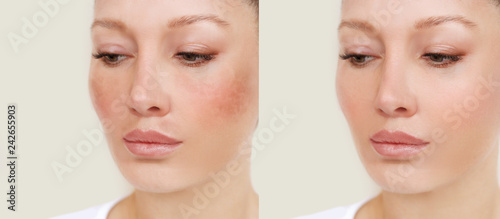 Quadro em tela Dark spots, freckles,hyperpigmentation(melasma or chloasma)