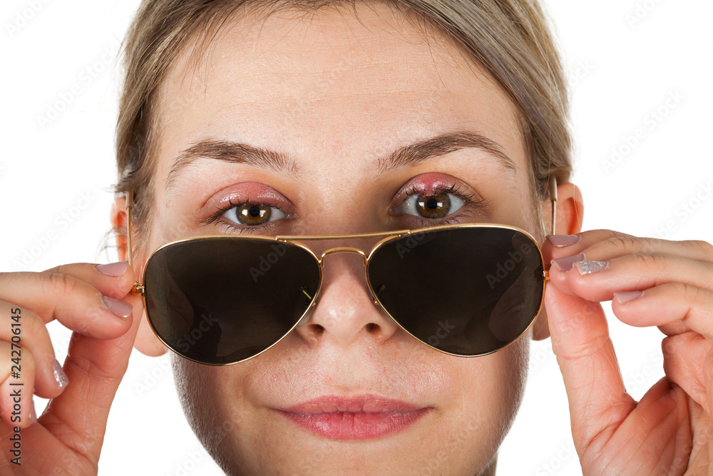 Infected upper eyelids Infected upper eyelids