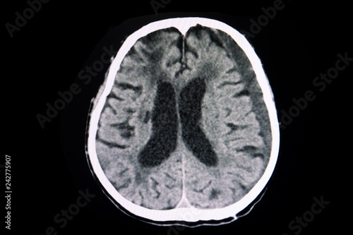 CT brain in trauma patient with subacute subdural hematoma