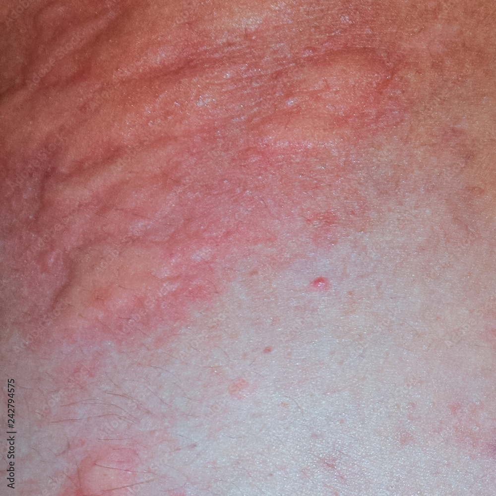 Allergy skin back and sides. Allergic reactions on the skin in t