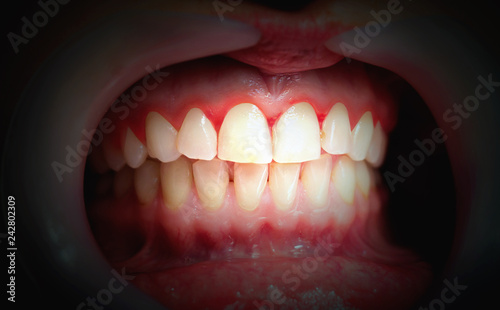Mouth with bleeding gums on a dark background