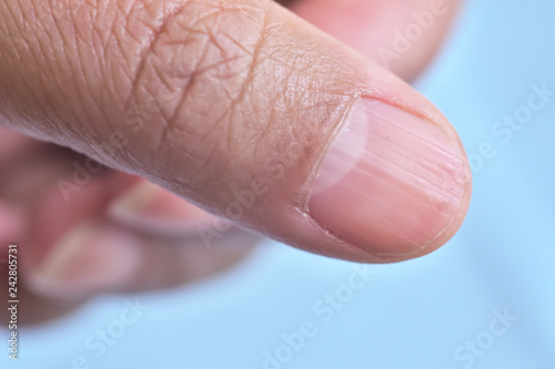 Lunula and longitudinal ridging nail on thumb. ( vertical nail ridges). The common causes of the ridges are health conditions, nutrient  deficiencies, get older, eczema and hypothyroidism.  © naowarat