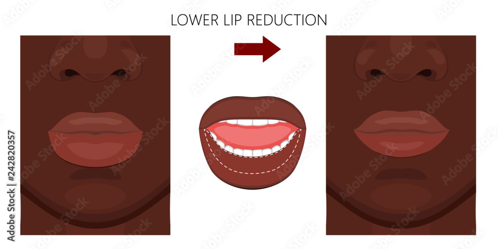 Vector illustration. African American lower lip reduction before, after