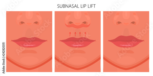 Vector illustration. Subnasal lip lift steps on women face, after procedure. Close up view. For advertising of medicinal, cosmetic and plastic surgery and procedures