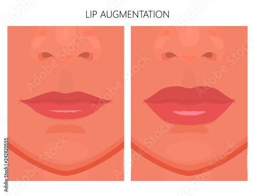 Vector illustration. Lips augmentation on women face, after procedure. Close up view. For advertising of medicinal, pharmacy products, cream, lotion, cosmetic and plastic procedures