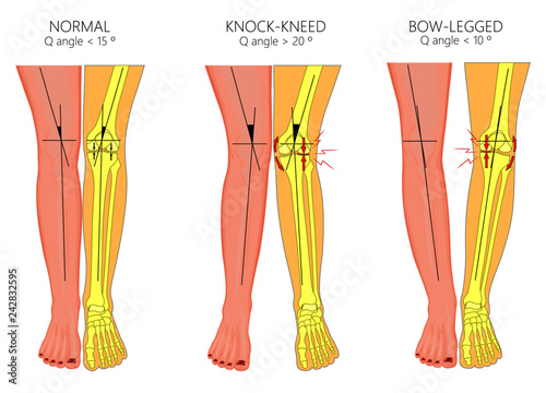 Vector illustration diagram. Shapes of human legs. Normal and curved legs. Knock knees. Bowed legs. Genu valgum and genu varum. For advertising, medical publications