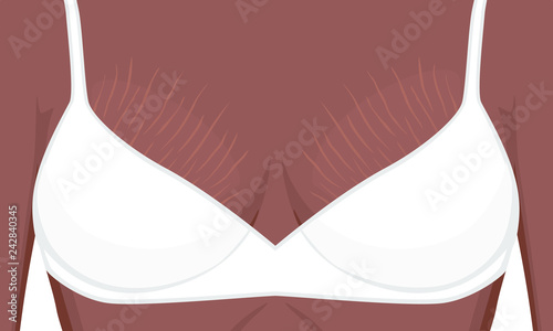 Vector illustration human body problem Stretch marks on  African American Indian woman, female breast For advertising, medical publications, use on package of medicinal products, creams, lotion
