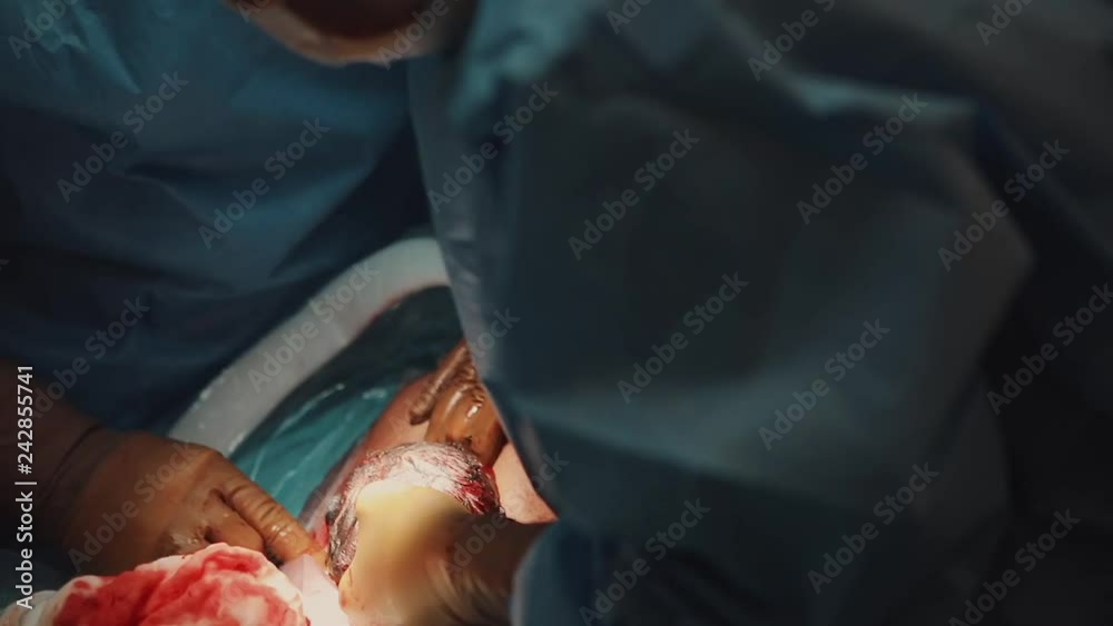 Close up cesarean section birth surgery. doctors hands wearing surgical gloves operating team protective clothing performing surgery using sterilized equipment during caesarean birth surgery operation