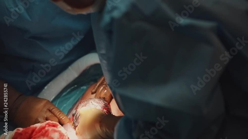 Close up cesarean section birth surgery. doctors hands wearing surgical gloves operating team protective clothing performing surgery using sterilized equipment during caesarean birth surgery operation photo