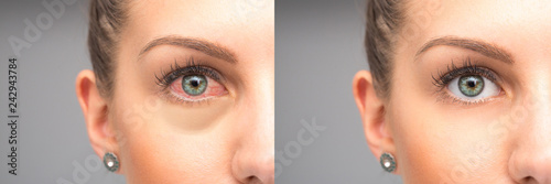 Woman red eyes before and after eye drops wash photo