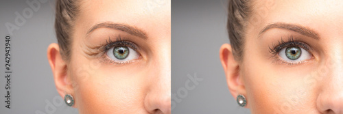 Woman eyes before and after krow's feet removal