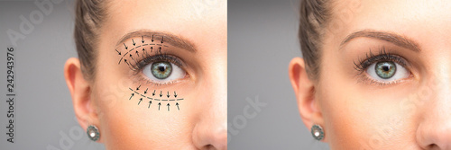 Female eyes before and after blepharoplasty photo