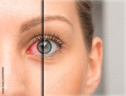 Red eye before and after eyedrop treatment photo