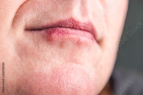 Herpes on the lips of woman. 