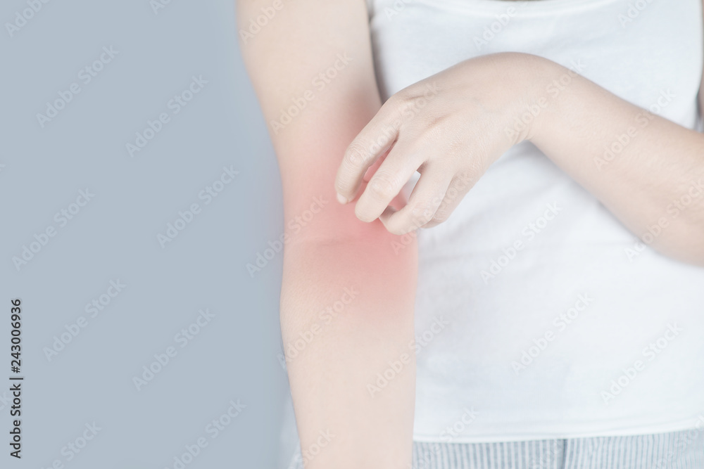 Woman scratching arm from itching on white background. Cause of itchy skin include insect bites, dermatitis, food/drugs allergies or dry skin. Concept of health care skin. Woman scratching arm from itching on white background. Cause of itchy skin include insect bites, dermatitis, food/drugs allergies or dry skin. Concept of health care skin.