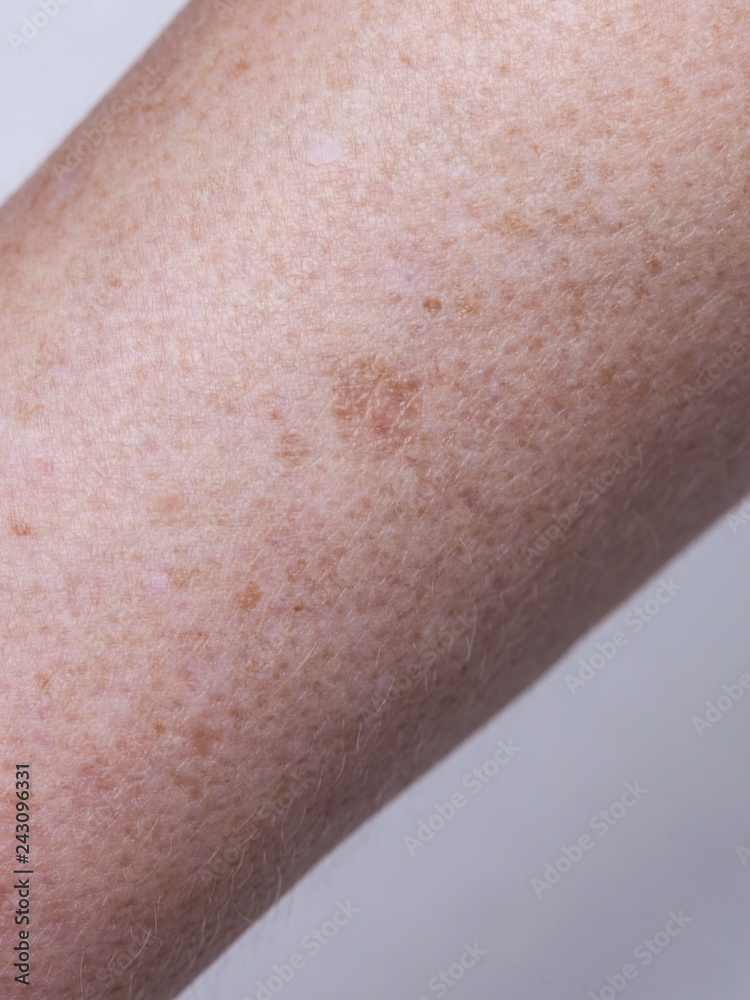 Naklejka premium Skin complexion discoloration, hyperpigmentation close up