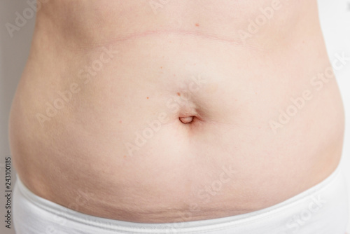 Excessive belly fat on white background. Umbilical hernia.