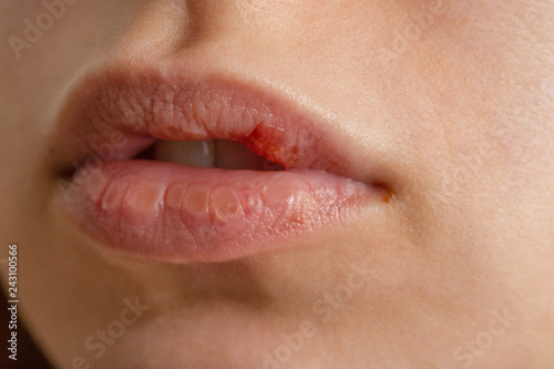 chilled female lip