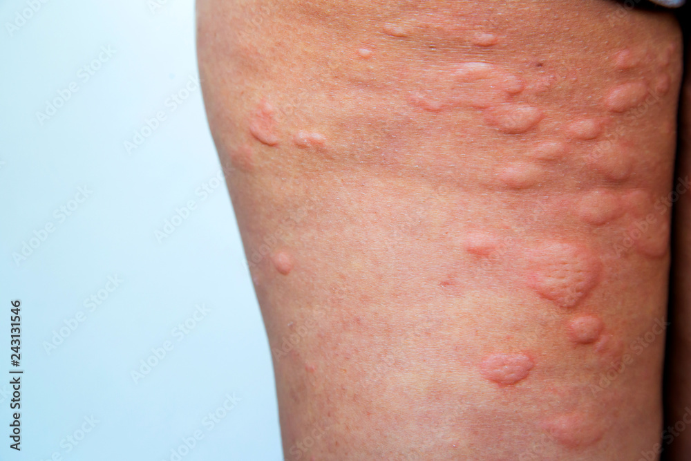Fototapeta premium Skin rash in the legs