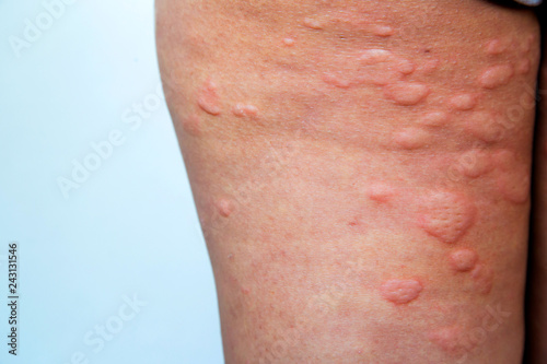 Skin rash in the legs photo