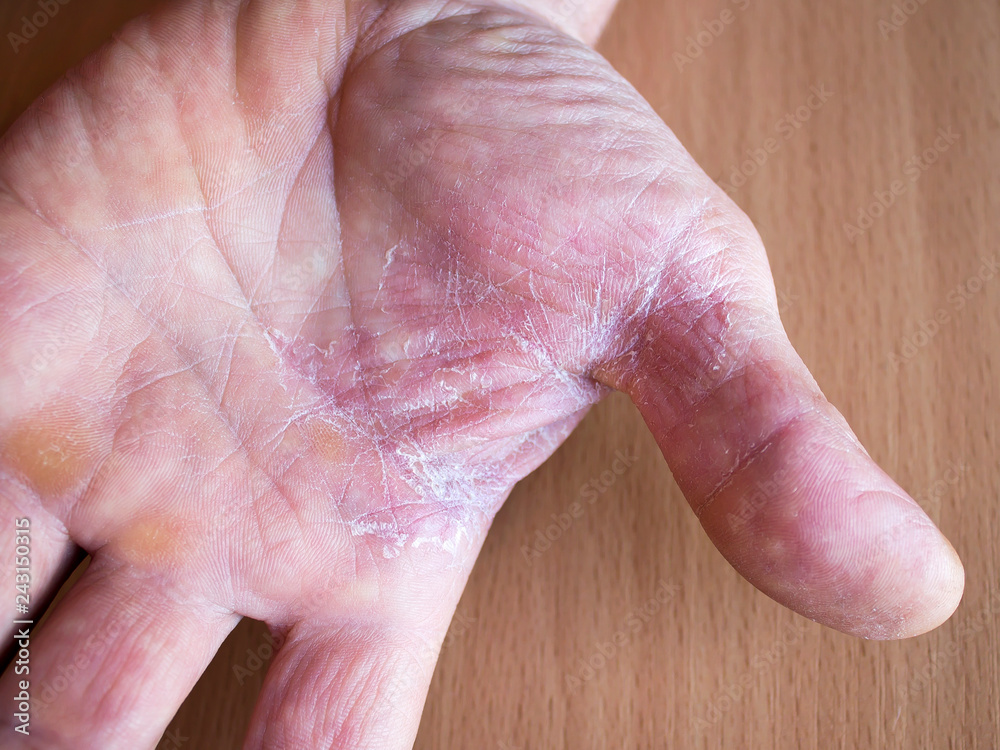 Peeling and dry skin of the hands. The concept of treatment and prevention  of skin diseases. Dermatology. Stock Photo | Adobe Stock