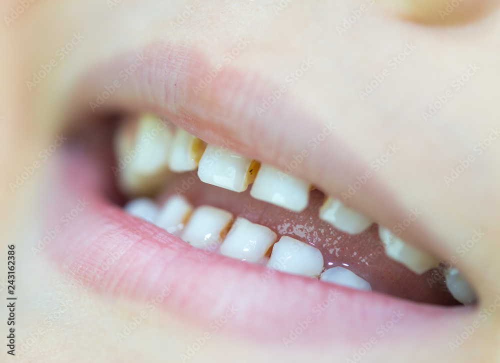 Fototapeta premium Six-year-old boy smiles, showing calf's teeth, mouth macro close-up