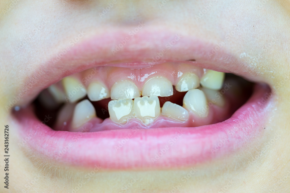 Obraz premium Six-year-old boy smiles, showing calf's teeth, mouth macro close-up
