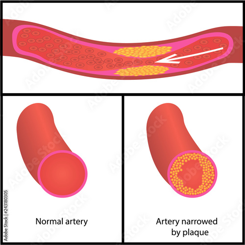 Levels of cholesterol plaque in vessels