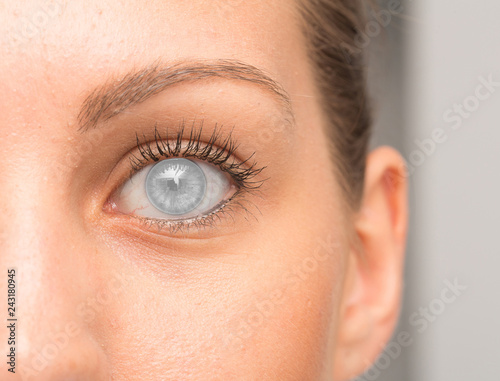 Rapresentation of eye with corneal opacity
