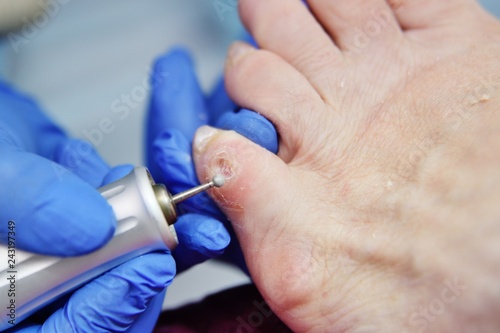 excision of calluses on the toe pedicure machine close-up photo