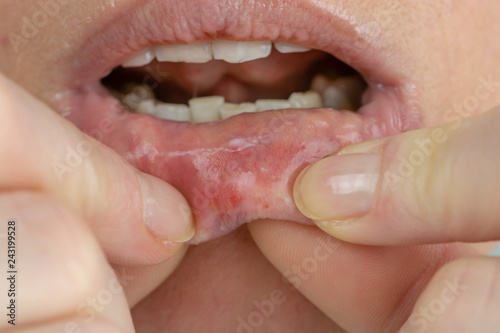 Woman with aphthae on lip