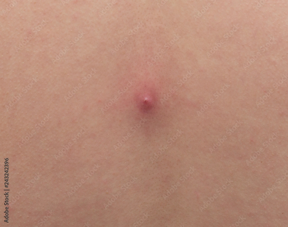 Big red pimple abscess on the skin, close-up, pimple inflammation on the skin, copy space, infection Big red pimple abscess on the skin, close-up, pimple inflammation on the skin, copy space, infection