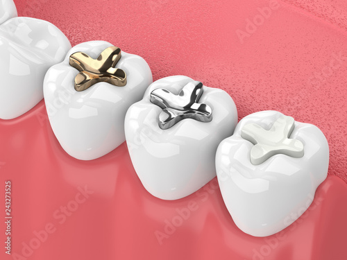 3d render of teeth with inlay photo