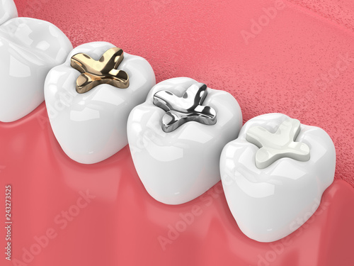3d render of teeth with inlay
