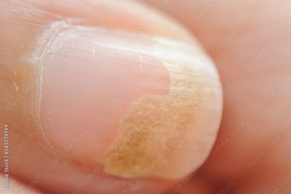 Fototapeta premium Onychomycosis or Fungal nail infection on forefinger
