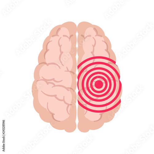Human brain with epilepsy activity isolated on white background.