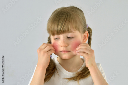 child, kid, has irritation on the face Allergy