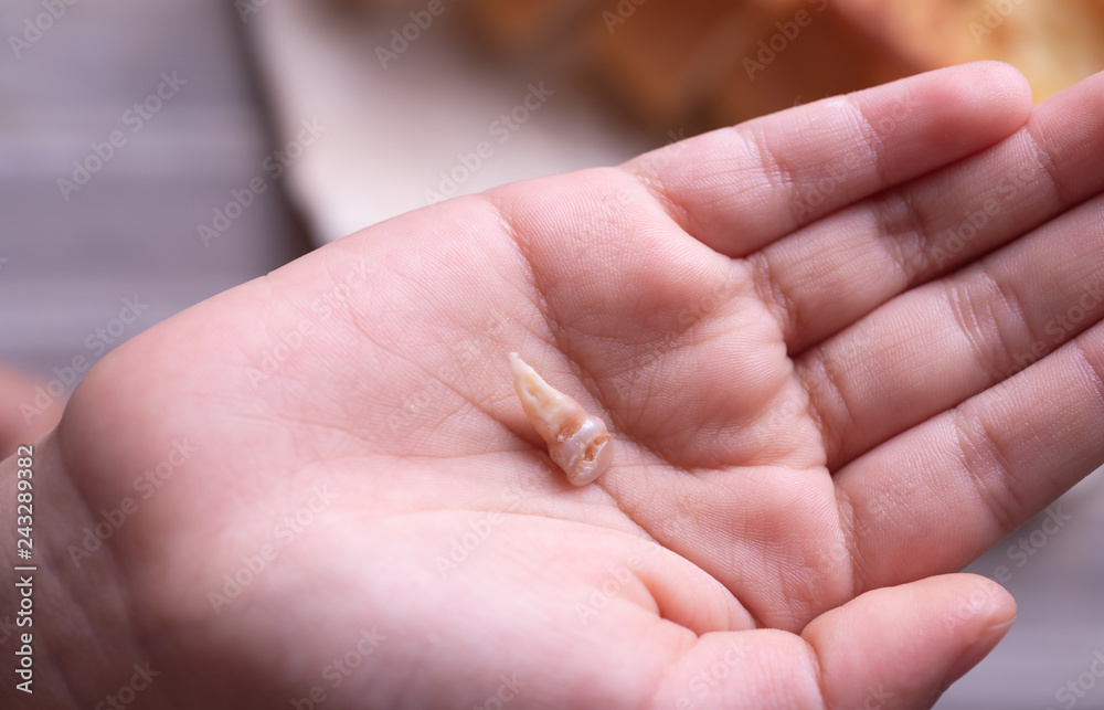 Child showing loose tooth in hand Child showing loose tooth in hand