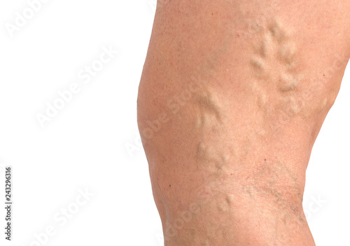 varicose veins on the skin macro close up circulation problem medicine concept photo