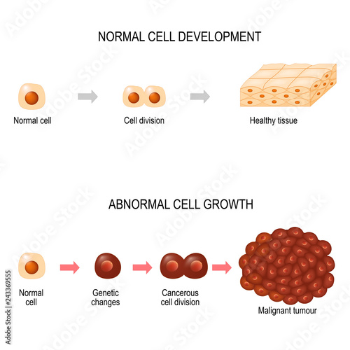 Cancer cell. illustration showing cancer disease development.