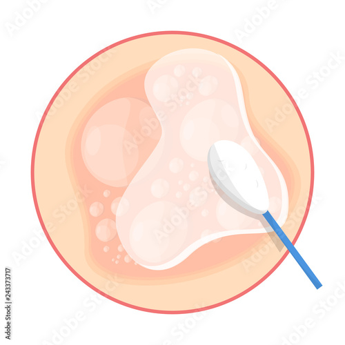 Herpes on the skin. Healthcare and dermatology