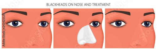 Vector illustration/ Blackheads on face problem (cheeks, nose) before, after treatment For placement on packaging of medicinal, pharmacy products, cream, lotion, cosmetic procedures advertising
