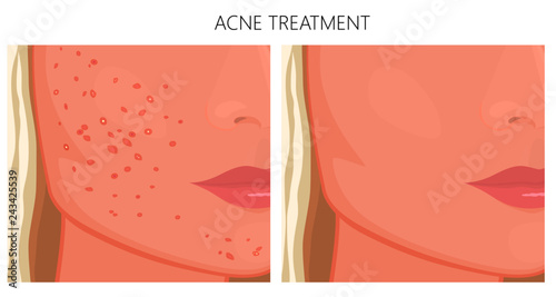 Vector illustration. Acne problem on face skin (cheeks, chin) before, after treatment. For placement on packaging of medicinal, pharmacy products, cream, lotion, cosmetic procedures advertising