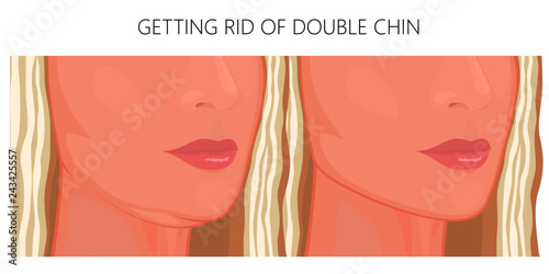 Vector illustration. Double chin on face in half turn before, after treatment. Close up view. For packaging of medicinal, pharmacy products, cream, lotion, cosmetic procedures advertising