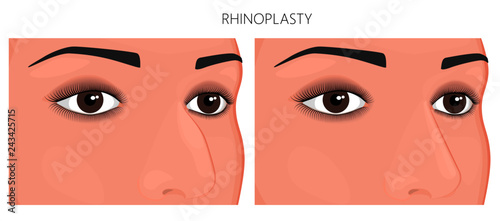 Vector illustration. Crookedness of human nose before, after rhinoplasty (nose job). Close up view. For advertising and medical publications